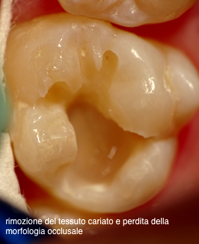 soggetto 1 dopo la rimozione della carie