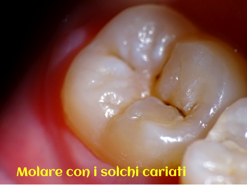 soggetto 2 prima della rimozione della carie